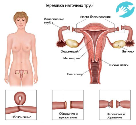 Естественным путем с перевязанными трубами забеременеть практически невозможно