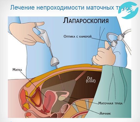 Лапароскопия наиболее современный способ лечения непроходимости маточных труб