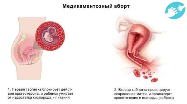 Многие специалисты считают, что забеременеть после медикаментозного прерывания беременности, будет легче, чем после аборта с хирургическим вмешательством