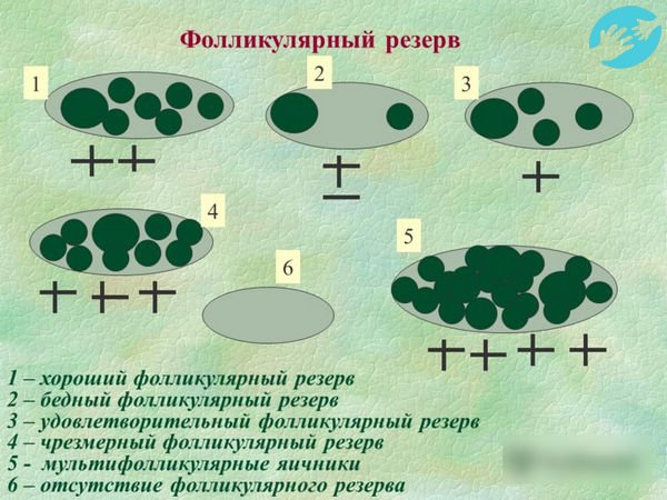 Нормой развития считается появление от 4 до 7-ми фолликулов, ежемесячно, при появлении более 8-ми, их называют мультифолликулярные яичники
