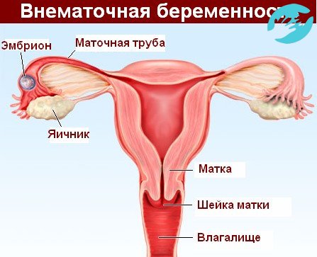 Опасным сигнал при длительной задержке может быть внематочная беременность, для тонного ее определения необходимо обратиться к врачу