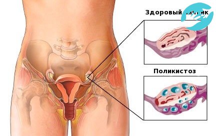 При поликистозе на восстановление уйдет не больше месяца, но овуляция восстанавливается значительно дольше