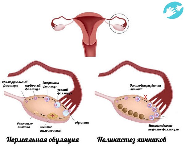 При поликистозе возможны изменения менструального цикла, внеплановые кровотечения, аменорея