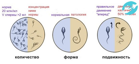 При расшифровке анализов врач обращает внимание на структурные изменения сперматозоидов