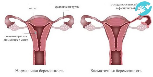 При сильных болях внизу живота необходимо срочно обратиться к врачу, для исключения внематочной беременности на УЗИ