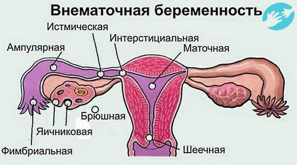 При устранении внематочной беременности понадобиться более долгий срок на восстановление организма, планировать беременность желательно, не ранее чем, через полгода