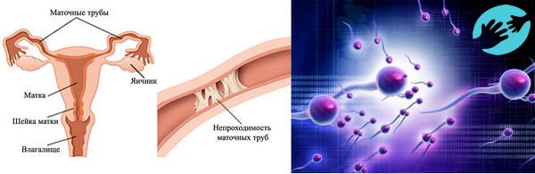 Чтобы получилось забеременеть время овуляции необходимо удостовериться, нет ли у пары таких осложнений как: гормональный сбой, непроходимость маточных труб, пониженная активность сперматозоидов или состояния цервикальной слизи