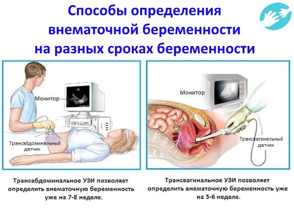Самым современным и быстрым методом распознавания внематочной беременности считается проведение УЗИ