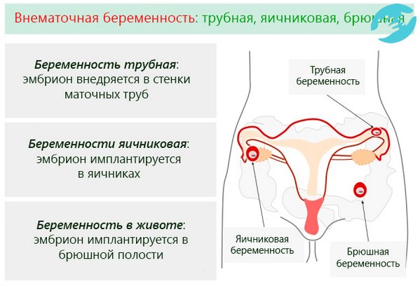 Внематочная беременность бывает: трубная, яичниковая, брюшная
