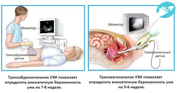 Существует два вида УЗИ трансвагинальное и абдоминальное
